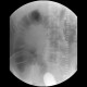 Carcinoma of transverse colon, ileus, perforation of bowel, peritonitis: RF - Fluoroscopy